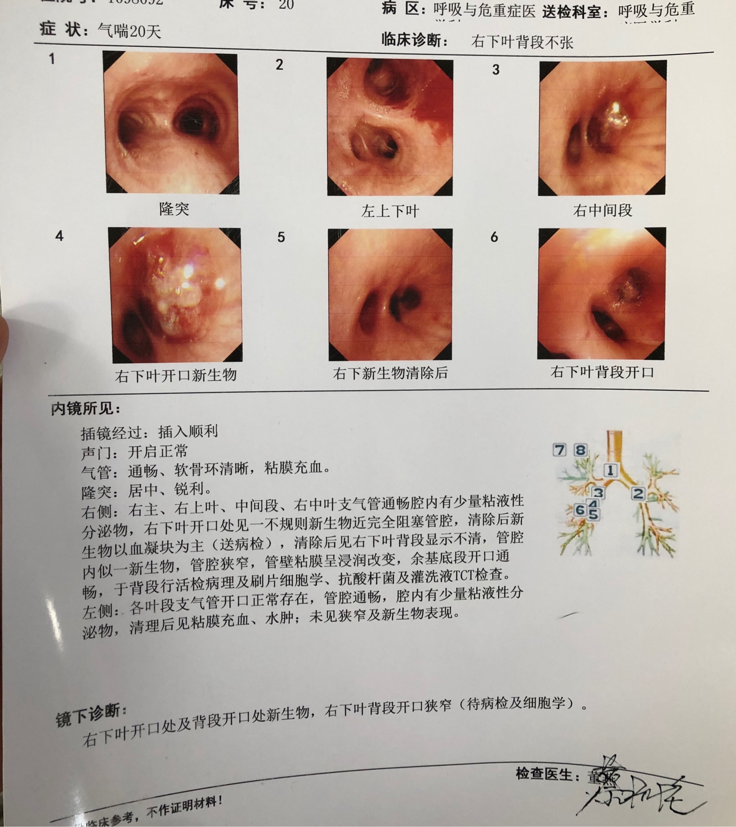 气管镜取病理图片