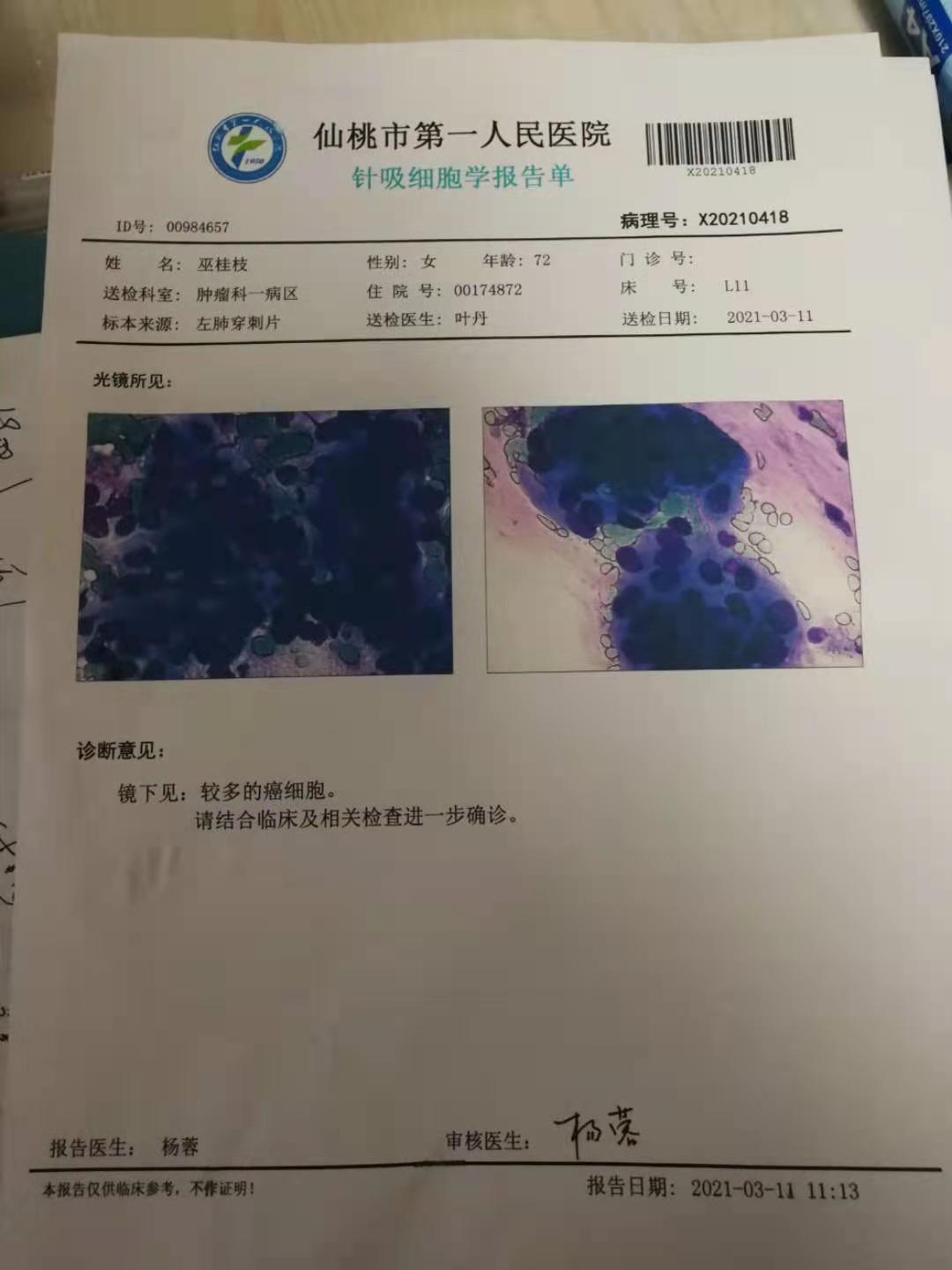 求助奶奶確診肺腺癌病理出來了請求分析