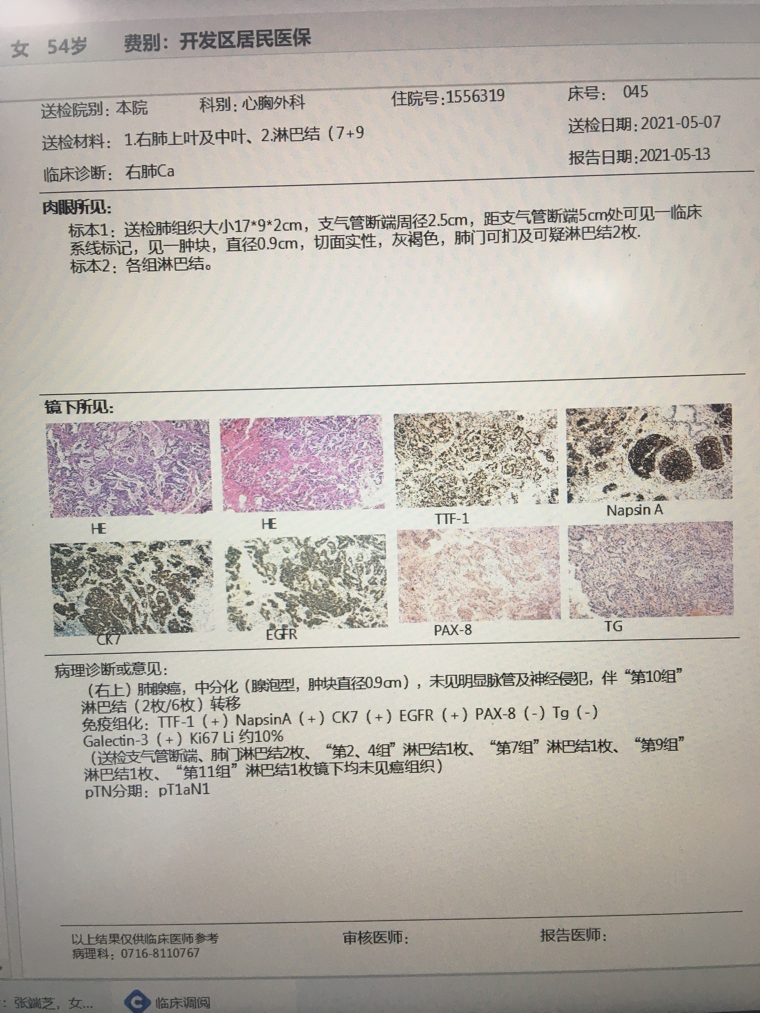 早期肺癌病理报告图片