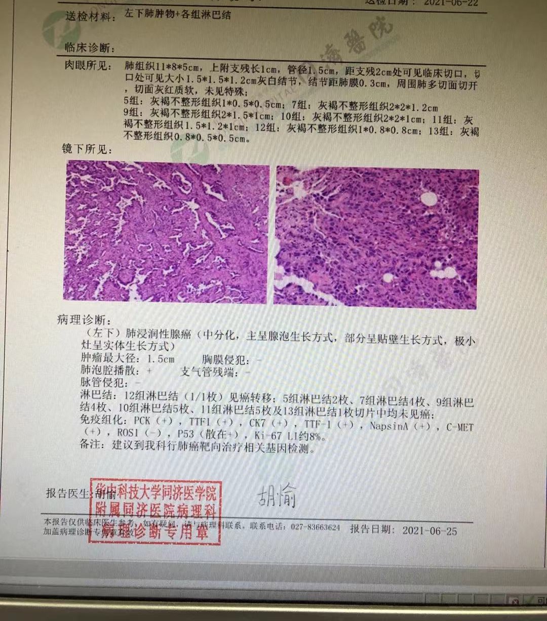 肺癌病理报告 模板图片