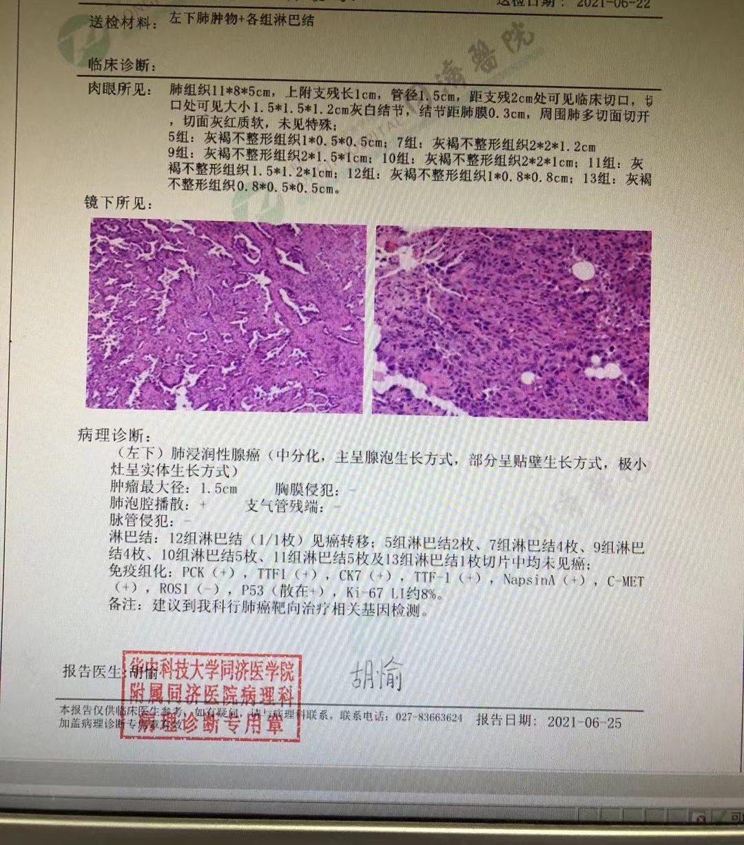 母亲肺腺癌iib期目前基因检查结果已出寻求治疗方案